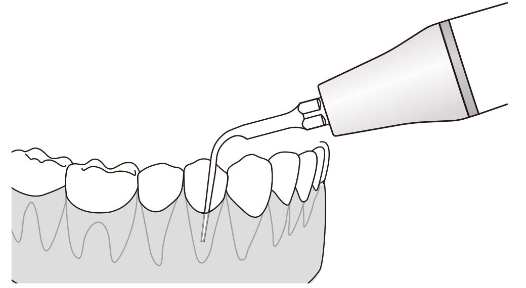 Сфера применения наконечника для скалера